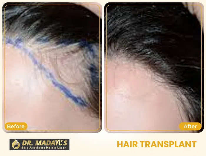 Hair transplant before and after result 5 at Dr Madan Aesthetics